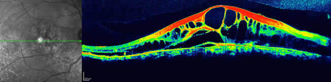 Optical Coherence Tomography Scan